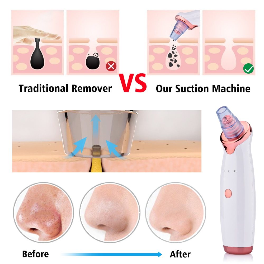 Blackhead Removal Tool